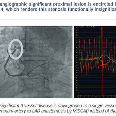 Right Coronary Artery