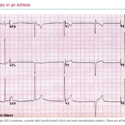 12-Lead ECG Changes in an Athlete