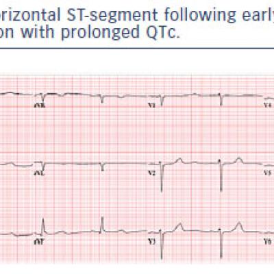 Horizontal ST-segment following early repolarisation with prolonged Qtc.