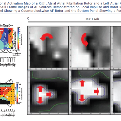 Repetitive focal Source During AF