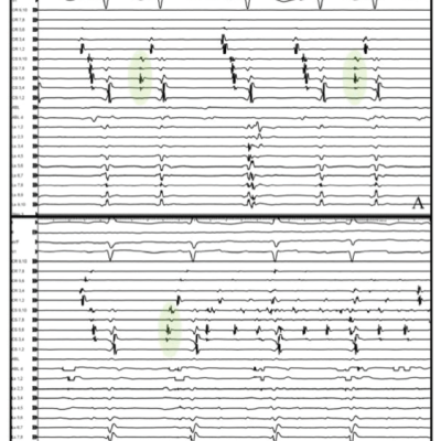 Activation in the Distal Duo-decapolar Catheter for Ectopic Bets Originating from the Coronary Sinus