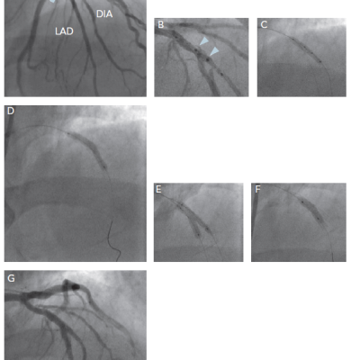 Figure 2 Bifurcation Lesion Stenting With A Tryton Side Branch Stent