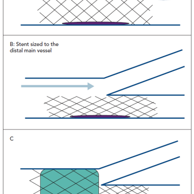 Figure 2 Bifurcation lesion