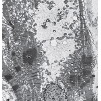 Figure 2. Cardiac Histology in HF with Reduced Ejection Fraction