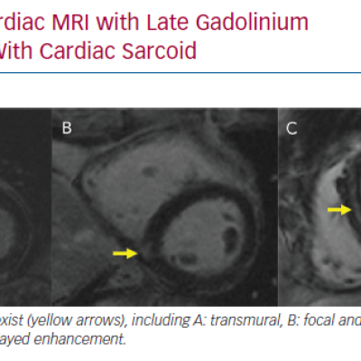 Cardiac MRI with Late Gadolinium in Patients With Cardiac Sarcoid