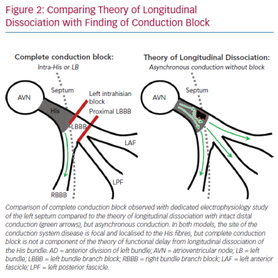 Comparing Theory of Longitudinal Dissociation with Finding of Conduction Block