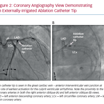 Coronary Angiography View Demonstrating an Externally-Irrigated Ablation Catheter Tip