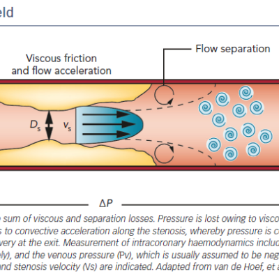 Figure 2 Diagram of Stenosis Flow Field