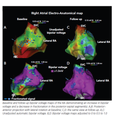 Electroanatomic Maps of the Right Atrium at Baseline