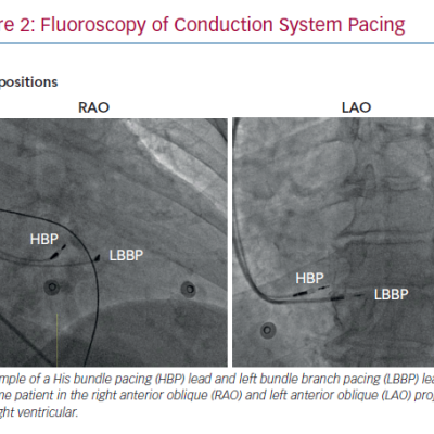 Fluoroscopy of Conduction System Pacing
