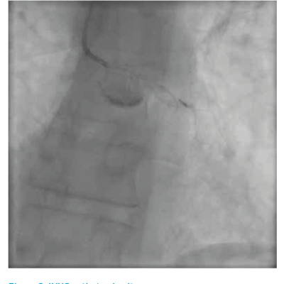 Figure 2. IVUS catheter in situ