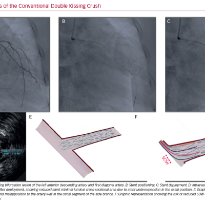 Limitations of the Conventional Double Kissing Crush