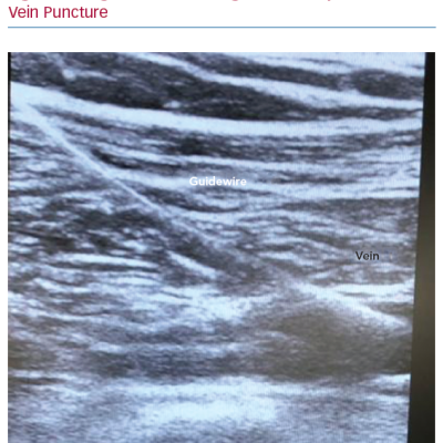 Long-Axis Ultrasound-guided Axillary Vein Puncture