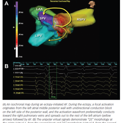 Mapping of Non-pulmonary Vein Triggers