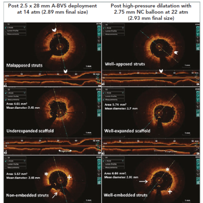 Figure 2 OCT Images of the Same Mid LAD Lesion