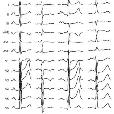 P-wave Morphology of Primary Focal Atrial Tachycardia from Different Pulmonary Veins