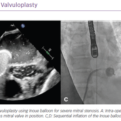 Percutaneous Balloon Mitral Valvuloplasty