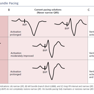 Figure 2 Potential of His Bundle Pacing