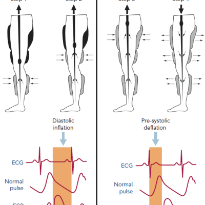 Figure 2 Principles of External Enhanced Counterpulsation