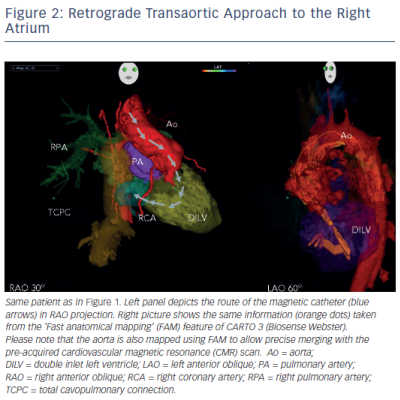 Retrograde Transaortic Approach to the Right Atrium