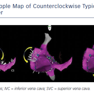 Ripple Map of Counterclockwise Typical Right Atrial Flutter