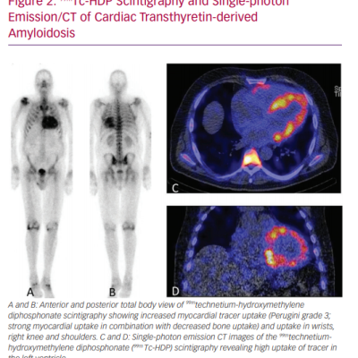 99mTc-HDP Scintigraphy and Single-photon Emission/CT of Cardiac Transthyretin-derived Amyloidosis