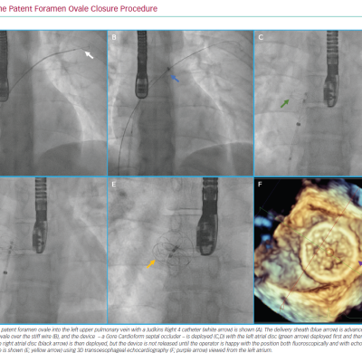 The Patent Foramen Ovale Closure Procedure