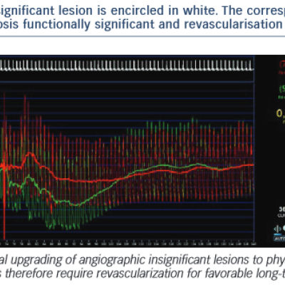 The corresponding FFR measurement of the lesion is 0.70 which renders this stenosis functionally significant and revascularisation is warranted.