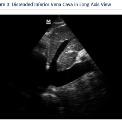 Distended Inferior Vena Cava In Long Axis View