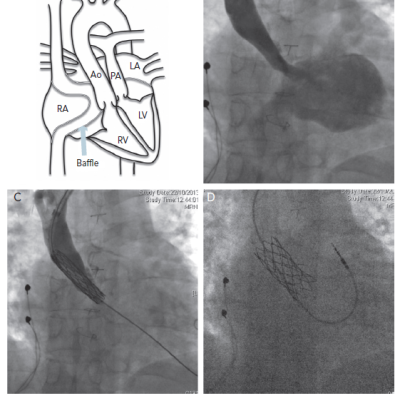 figure 3-Pacing-Following-Atrial-Switch-Procedure