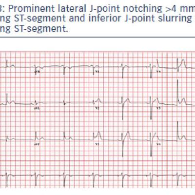 Prominent lateral J-point notching &ampgt4 mm with ascending ST-segment and inferior J-point slurring with ascending ST-segment.