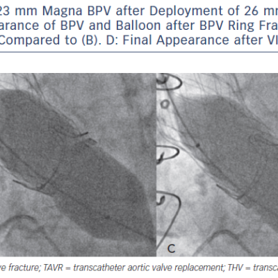 Figure 3 A Baseline Appearance of 23 mm Magna BPV