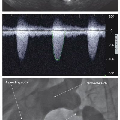 Coarctation Echocardiogram and Angiogram