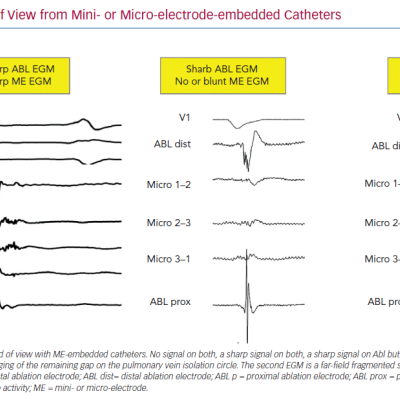 Combined Fields of View from Mini- or Micro-electrode-embedded Catheters