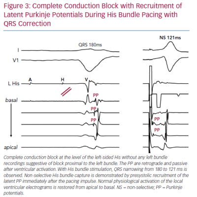Complete Conduction Block with Recruitment
