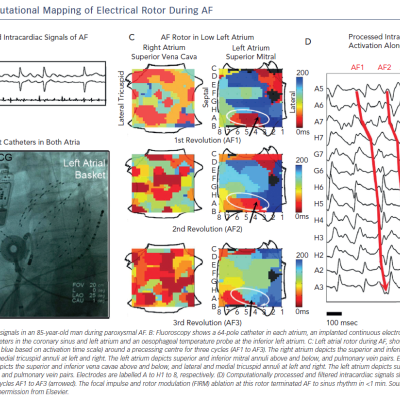 Figure 3 Computational Mapping of Electrical Rotor During AF