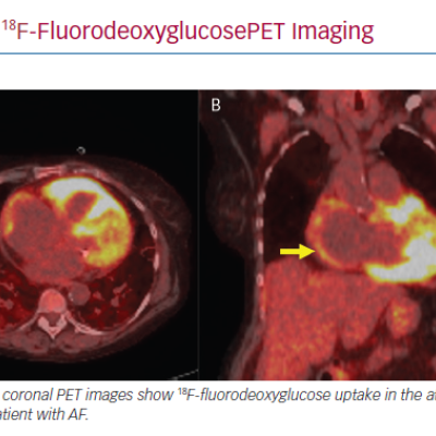 18F-FluorodeoxyglucosePET Imaging