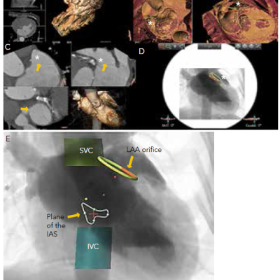 Figure 3 Measurements of the Left Atrial Appendage LAA