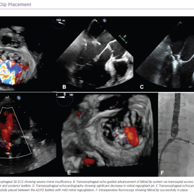 MitraClip Placement