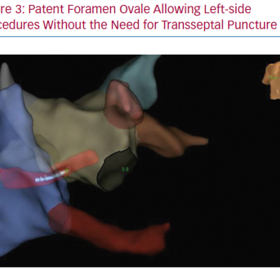 Patent Foramen Ovale Allowing Left-side Procedures