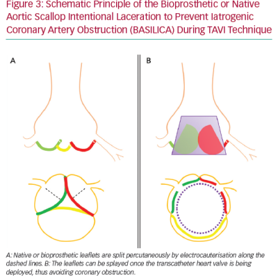 Schematic Principle of the Bioprosthetic