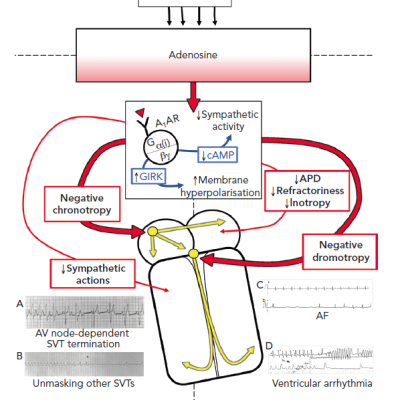 Summary of the Contributions of Adenosine to Arrhythmia