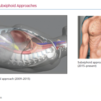 Transabdominal and Subxiphoid Approaches
