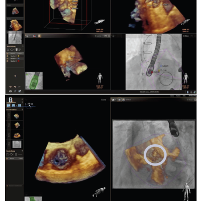 A EchoNavigator® During Transcatheter Aortic Valve Replacement Procedures. B Use of EchoNavigator Release II During Transcatheter Aortic Valve Implantation Procedures