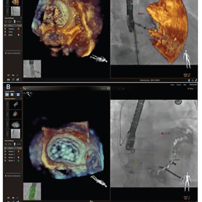 EchoNavigator® During MitraClip® Procedures