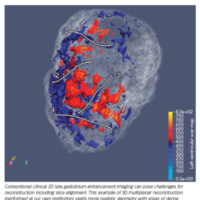 3D Multiplanar Reconstruction