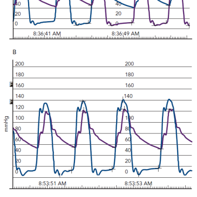 Figure 4 A Baseline Haemodynamics Prior to VIV TAVR