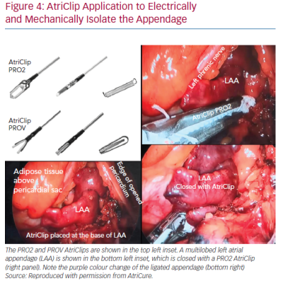 AtriClip Application to Electrically and Mechanically Isolate the Appendage