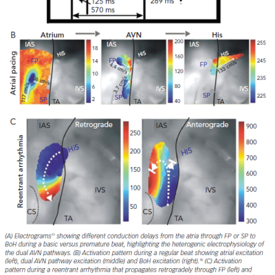 Figure 4 Conduction Through the Dual AVN Pathways