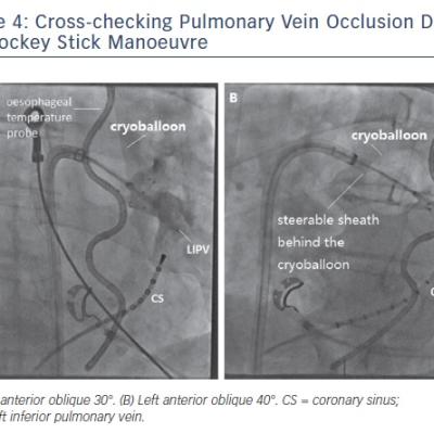 Figure 4 Cross-checking Pulmonary Vein Occlusion During the Hockey Stick Manoeuvre